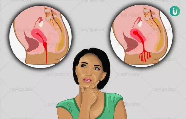Heavy implantation bleeding or period. Early sign of pregnancy