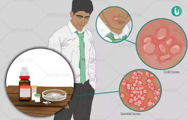 Homeopathic medicine, treatment and remedies for Herpes