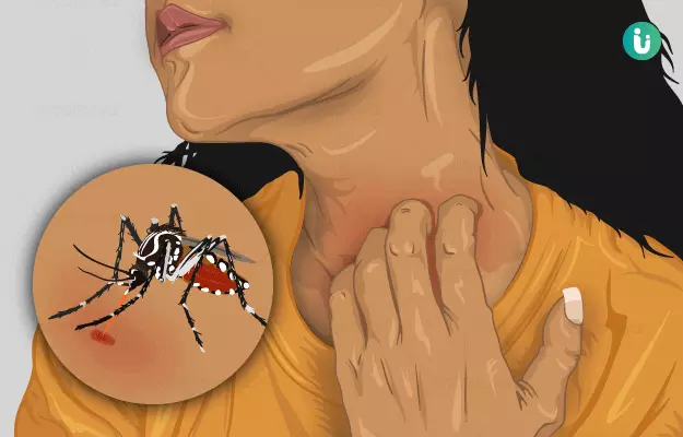 How to stop mosquito bites from itching