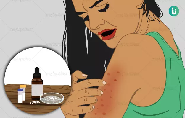 त्वचा पर चकत्ते की होम्योपैथिक दवा और इलाज - Homeopathic medicine and treatment for Skin Rashes in Hindi