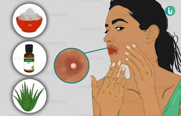 Home remedies for cold sores or fever blisters