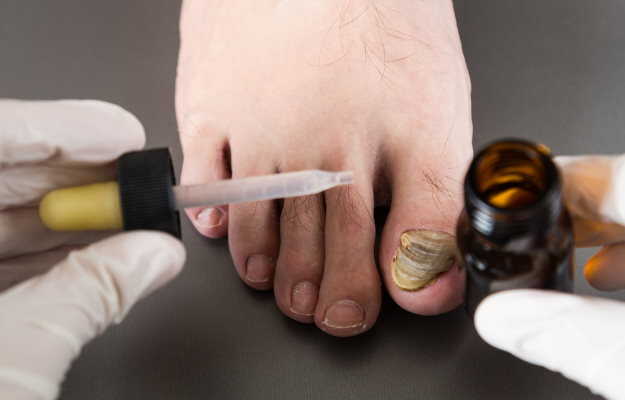 नाखून में फंगल इंफेक्शन के घरेलू उपाय - Home remedies for toe nail fungus  in Hindi