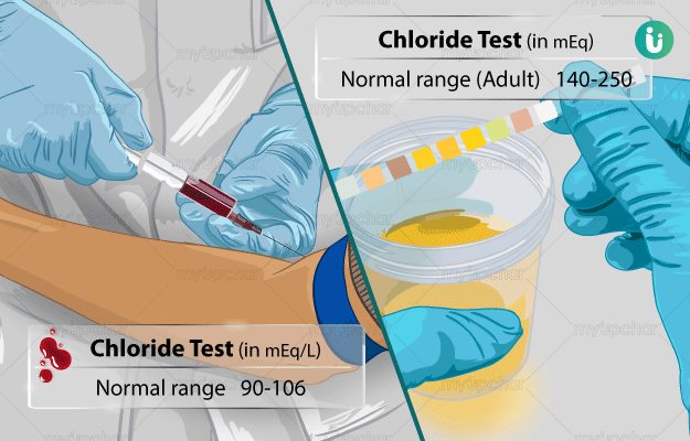 Chloride Test Procedure Purpose Results Normal Range Cost Price Online Booking 3743