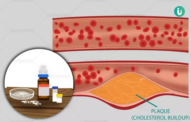 Homeopathic medicines, treatment and remedies for high cholesterol