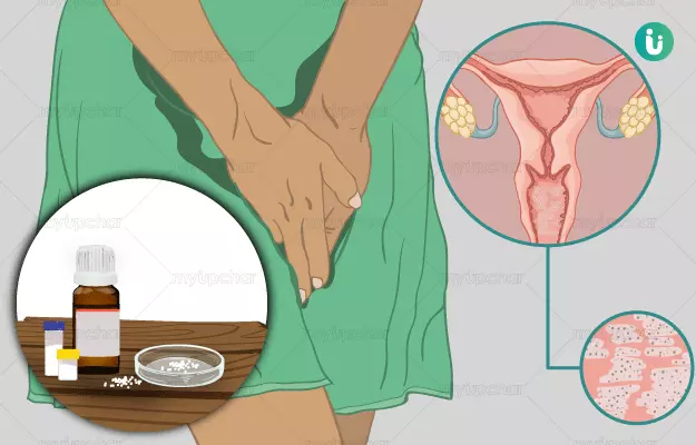 योनि में यीस्ट संक्रमण की होम्योपैथिक दवा और इलाज - Homeopathic medicine and treatment for vaginal yeast infection in hindi