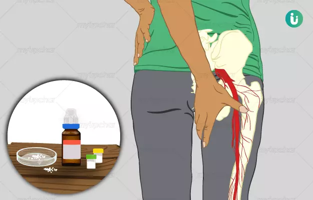Homeopathic medicine, treatment and remedies for Sciatica