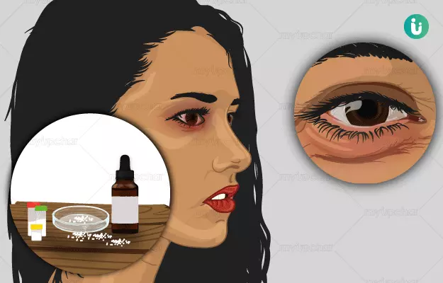 Homeopathic medicine, treatment and remedies for Swollen Eyes
