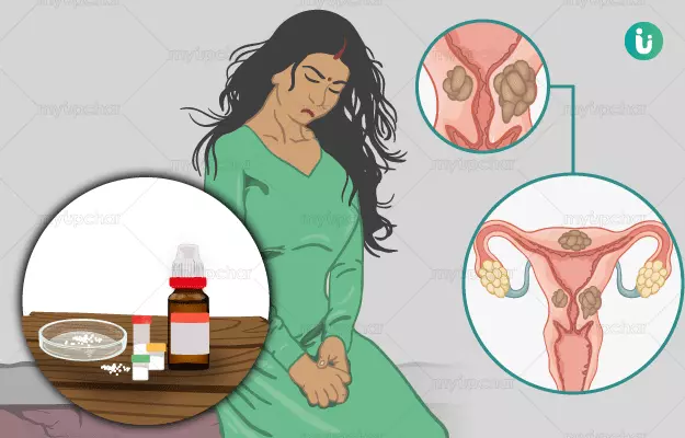 गर्भाशय में रसौली की होम्योपैथिक दवा और इलाज - Homeopathic medicine and treatment for Uterine fibroids in Hindi