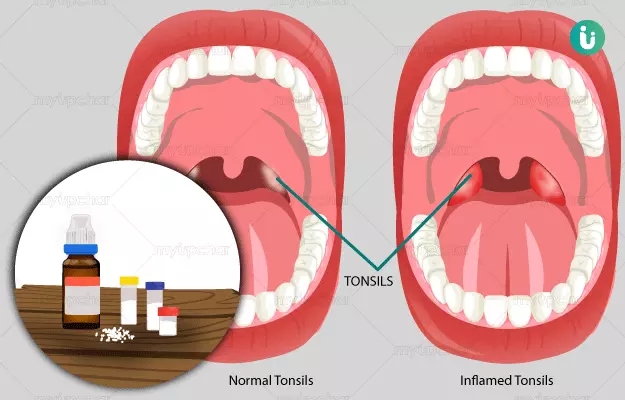 Homeopathic medicine, treatment and remedies for Tonsillitis
