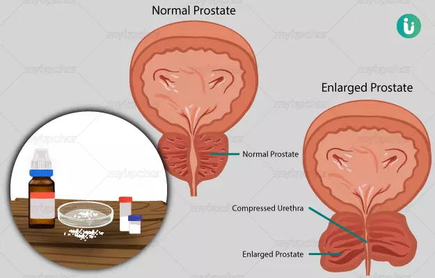प्रोस्टेट बढ़ने की होम्योपैथिक दवा और इलाज - Homeopathic medicine, treatment for Enlarged prostate in Hindi