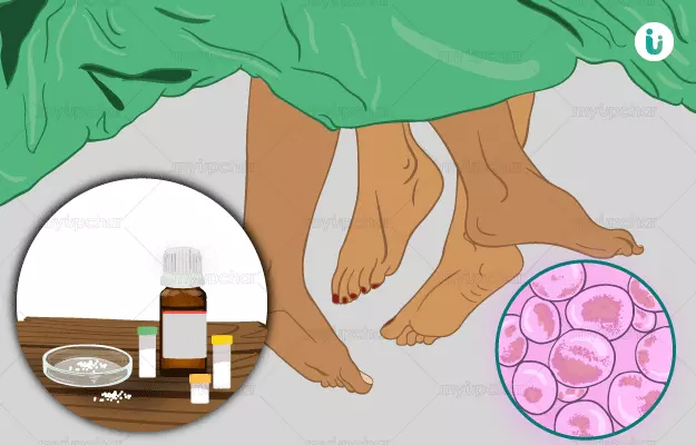 Homeopathic medicine, treatment and remedies for Gonorrhea