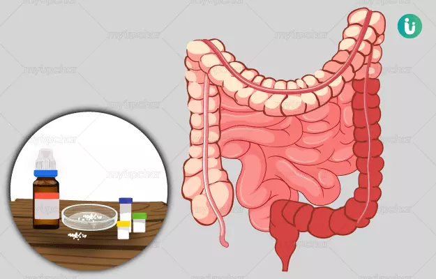 Homeopathic medicine, treatment and remedies for Ulcerative Colitis