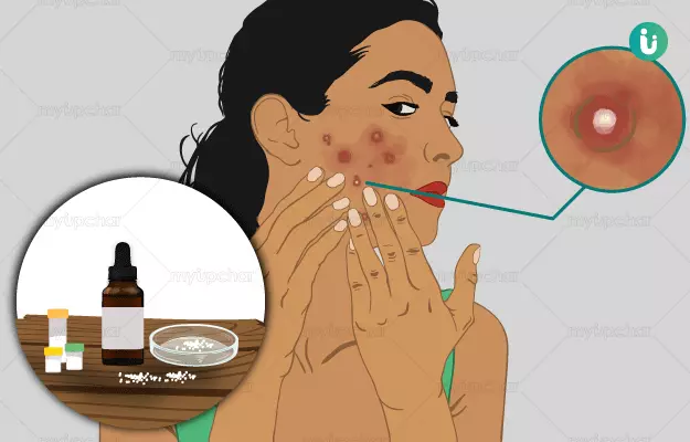 Homeopathic medicine, treatment and remedies for Acne