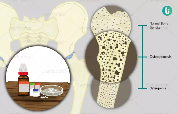 Homeopathic medicine, treatment and remedies for Osteoporosis