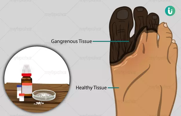 Homeopathic medicine, treatment and remedies for Gangrene