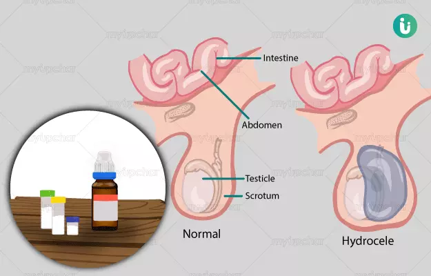 Homeopathic medicine, treatment and remedies for Hydrocele