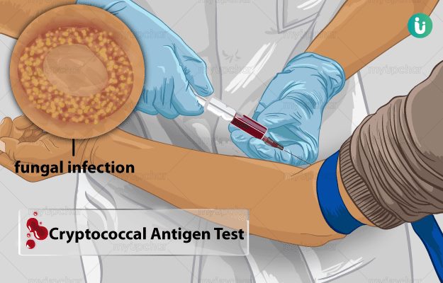 crypto antigen positive