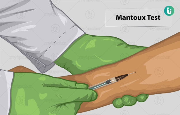 mantoux-test