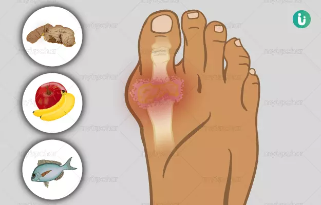 Home remedies for gout pain