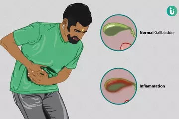 Gallbladder Removal: Understanding Its Impact on Your Body