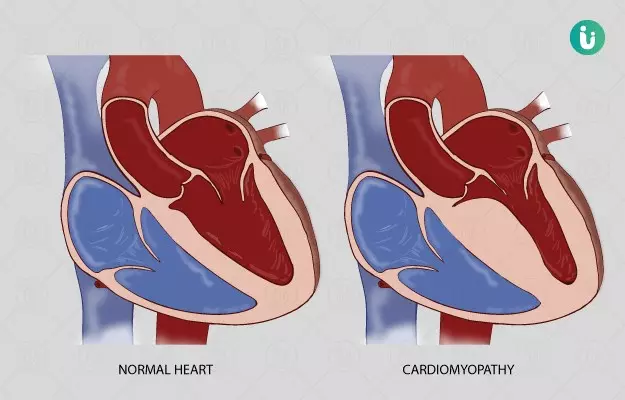 इन वजहों से कमजोर हो जाती हैं हृदय की मांसपेशियां