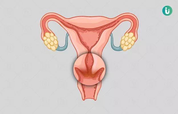 गर्भाशय ग्रीवा निकालने की सर्जरी - Cervicectomy in Hindi