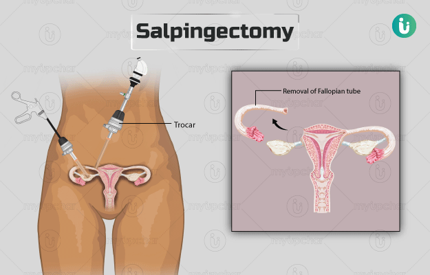 फैलोपियन ट्यूब निकालने की सर्जरी - Salpingectomy in Hindi