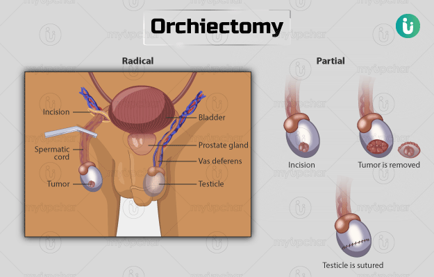 अंडकोष (वृषण) निकालने की सर्जरी - Orchiectomy in Hindi