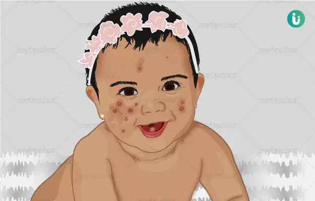 शिशु के चेहरे पर दाने - Baby Acne