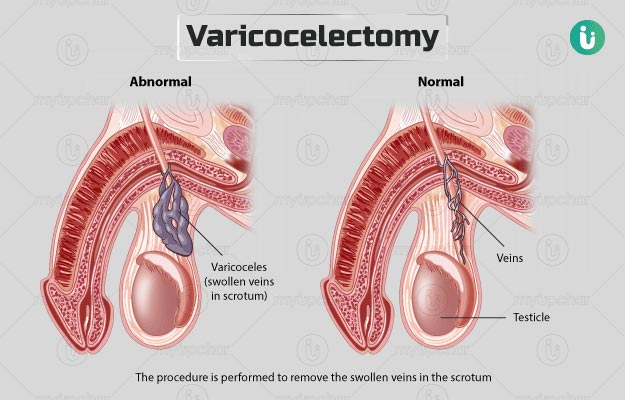 Varicocele | Tan Urology