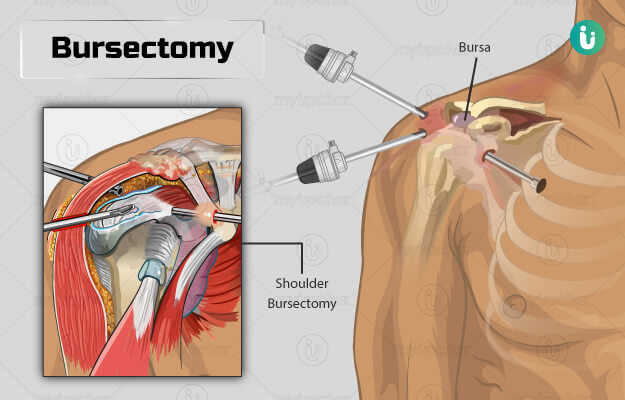 बर्सा निकालने की सर्जरी - Bursectomy in Hindi