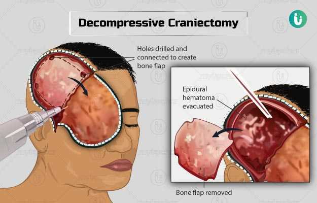 डिकंप्रेसिव क्रेनिएक्‍टोमी - Decompressive craniectomy in Hindi