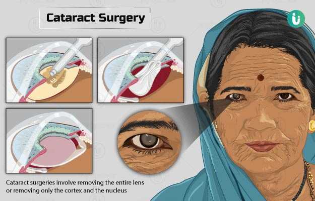 मोतियाबिंद का ऑपरेशन - Cataract Surgery in Hindi