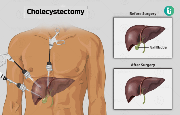 Gallbladder removal (Cholecystectomy)