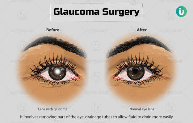 काला मोतियाबिंद का ऑपरेशन - Glaucoma Surgery in Hindi
