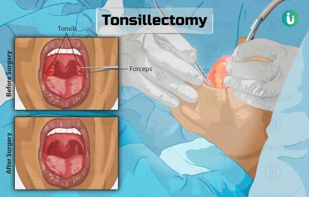 टॉन्सिल्स निकालने की सर्जरी - Tonsils ka operation in hindi