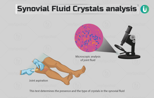 Synovial fluid crystals analysis: Procedure, Purpose, Results, Cost ...