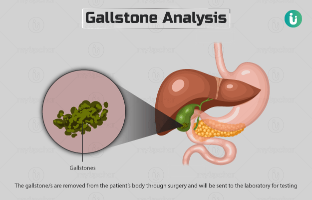 Gallstone analysis Procedure Purpose Results Cost Price