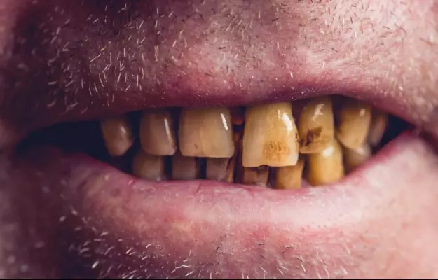 धूम्रपान के नुकसान दांतों, मसूड़ों और मुंह के स्वास्थ्य के लिए - Smoking Effects on Teeth, Gums and Oral Health in hindi
