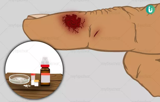 चोट (घाव) के निशान हटाने की होम्योपैथिक दवा और इलाज - Homeopathic medicine and treatment for Scar removal in Hindi